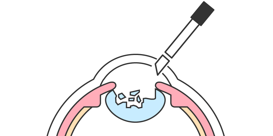 水晶体の吸引