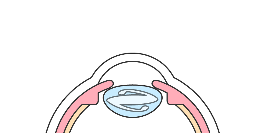 眼内レンズ挿入