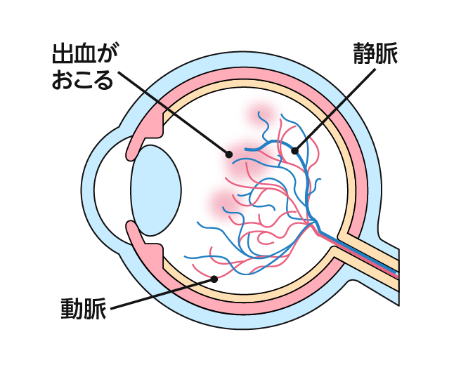 網膜静脈閉塞症